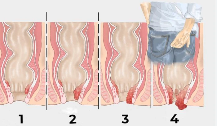 Sagnat rectal i sensació de pressió anal: hemorroides o tumor?